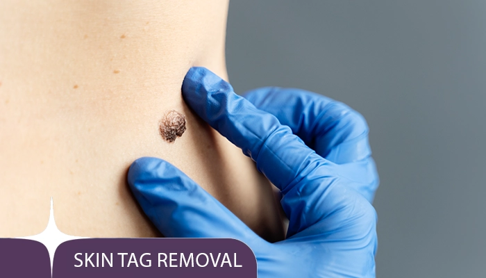 Skin Tag Removal Treatment at nour